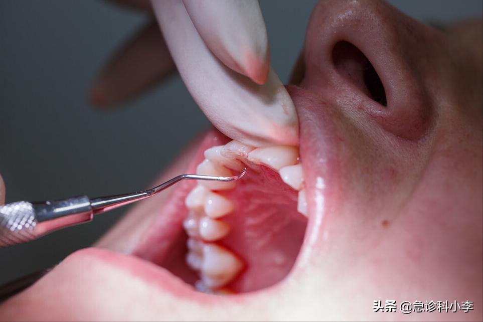 牙缝里的牙结石如何清除干净,牙缝里的牙结石怎么去除