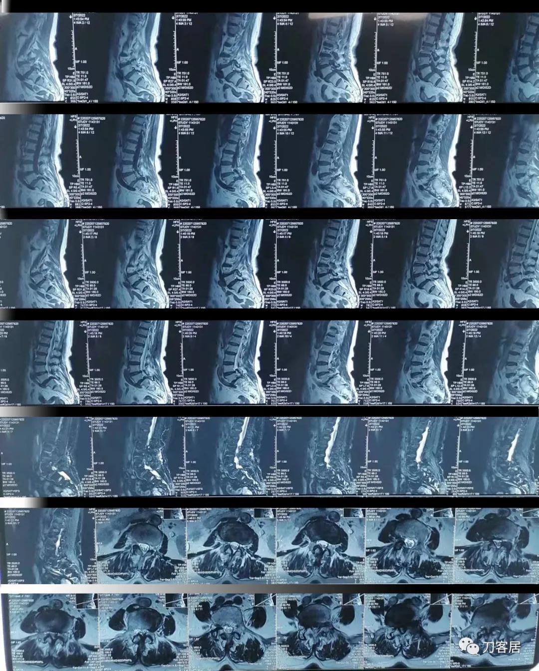 老年人腰骨裂不手术怎么治疗最好,老年腰椎骨质疏松症