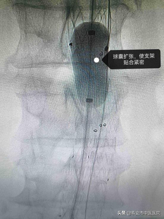 【创新技术】*安泰**市中医医院介入诊疗科：精准影像介入治疗，排除腹主动脉“不定时*弹炸**”