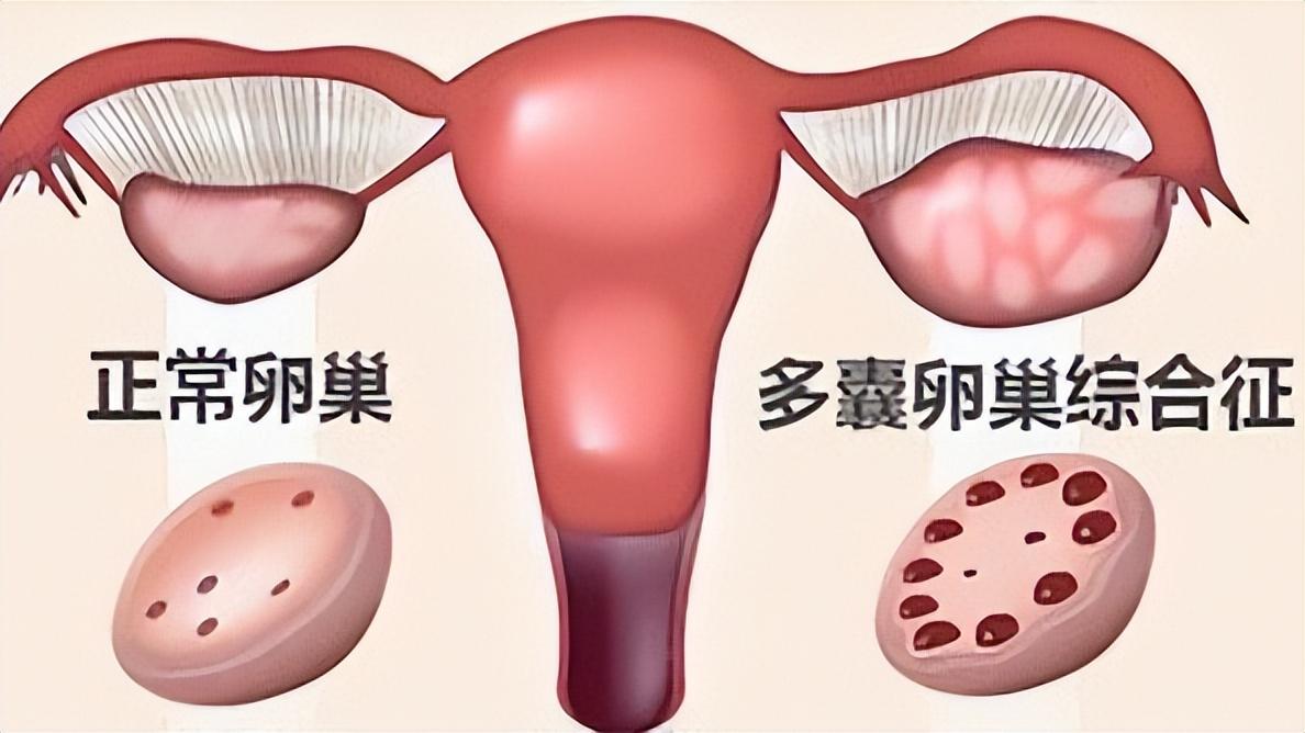 多囊卵巢综合征导致月经推迟长痘,多囊综合征女士脱发