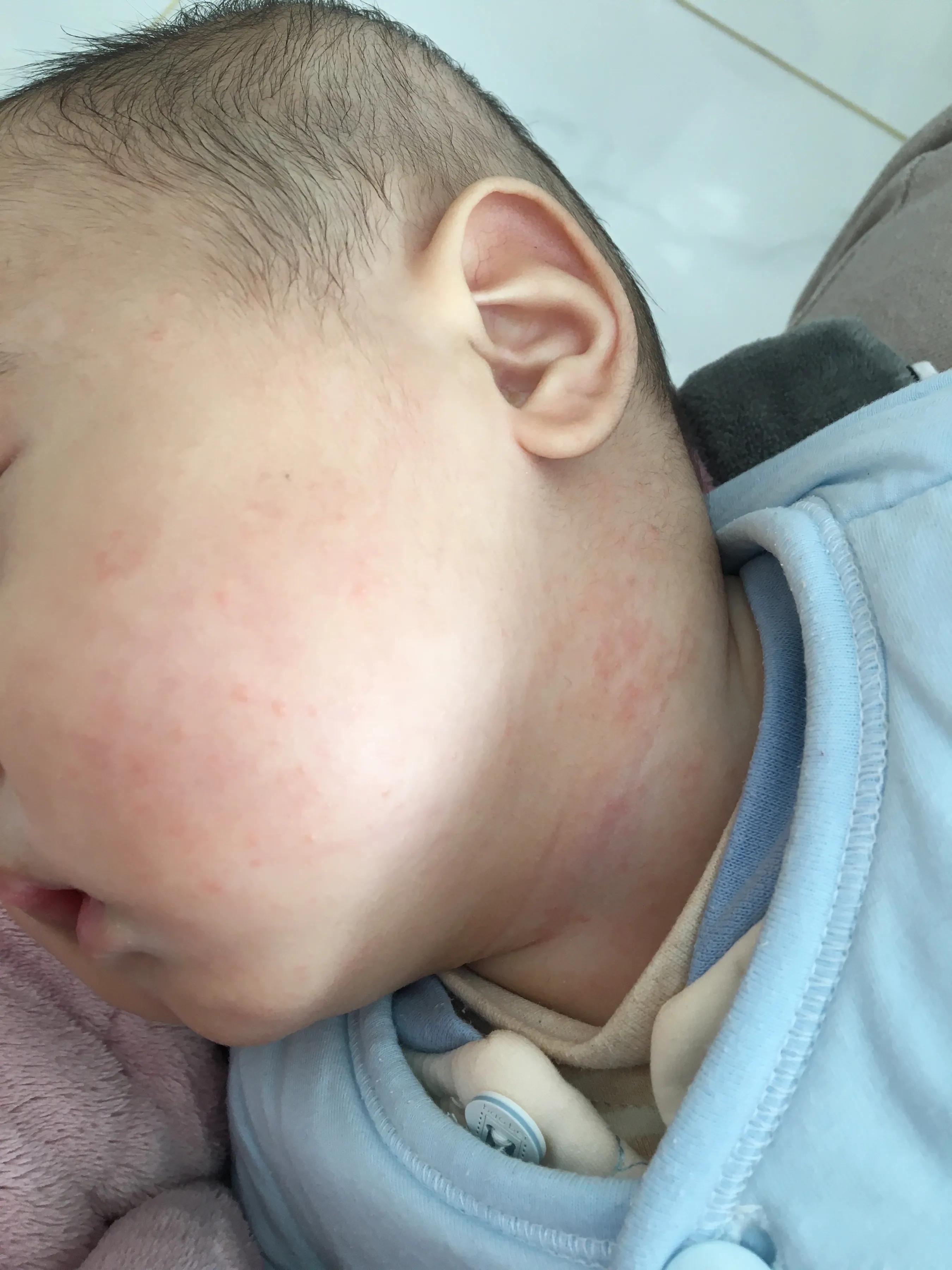 宝宝湿疹母亲有什么忌口的吗,婴儿湿疹大作战之护理的6大要点