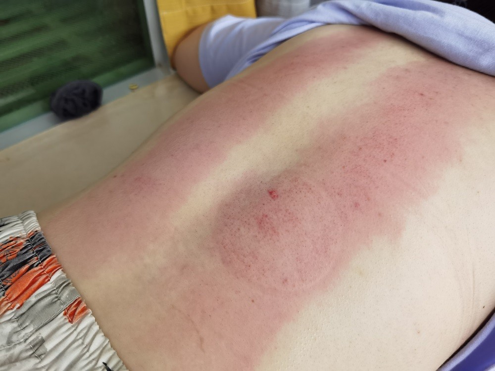 中医脚底筋膜炎如何彻底治愈,筋膜炎肩部最快的治疗方法中医