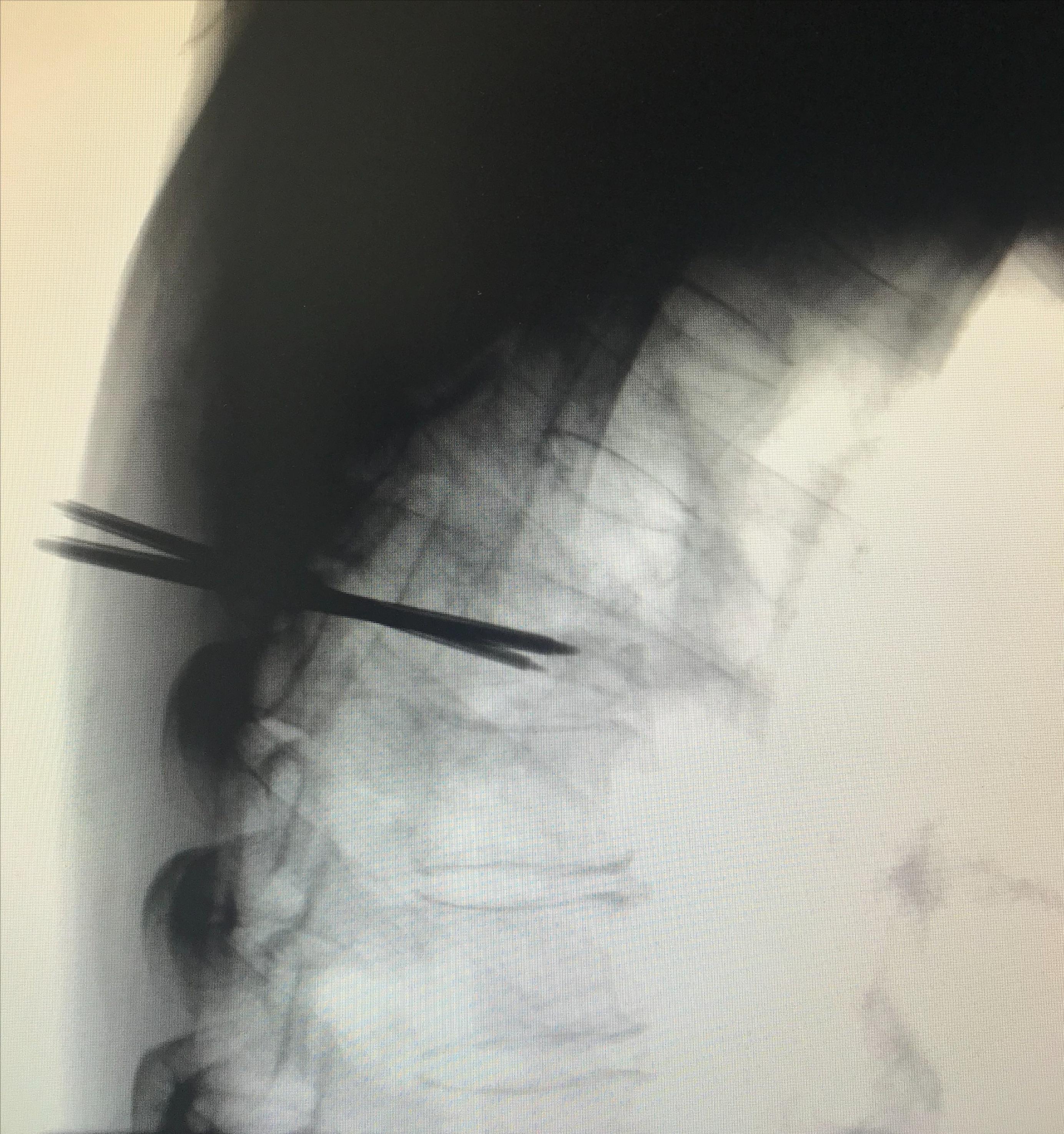 胸椎压缩性骨折微创手术利弊,胸椎压缩性骨折保守治疗20例
