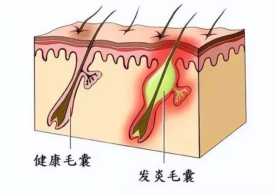 后背长毛囊炎怎么解决,后背长毛囊炎怎么彻底根治