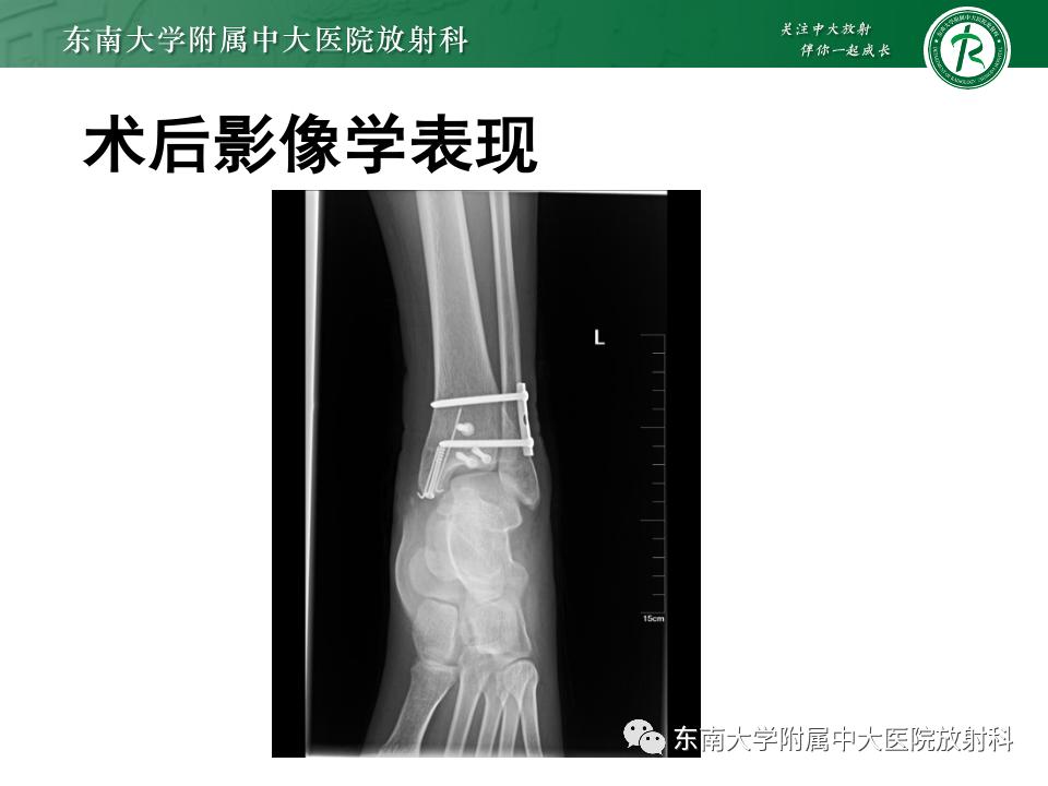 左腓骨下段骨折伴下胫腓联合分离,好文分享深度揭秘