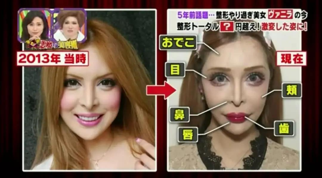 日本1米5小哥砸1600万疯狂整容增高！断骨惨烈过程吓傻网友