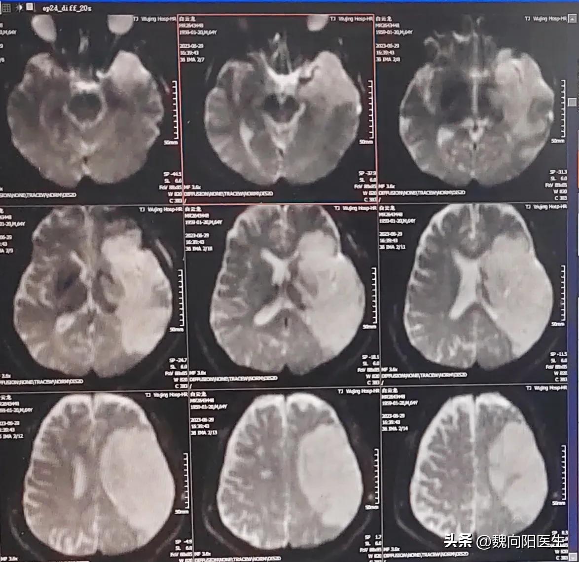 脑梗为什么要割掉神经,脑梗死为什么脑袋会疼