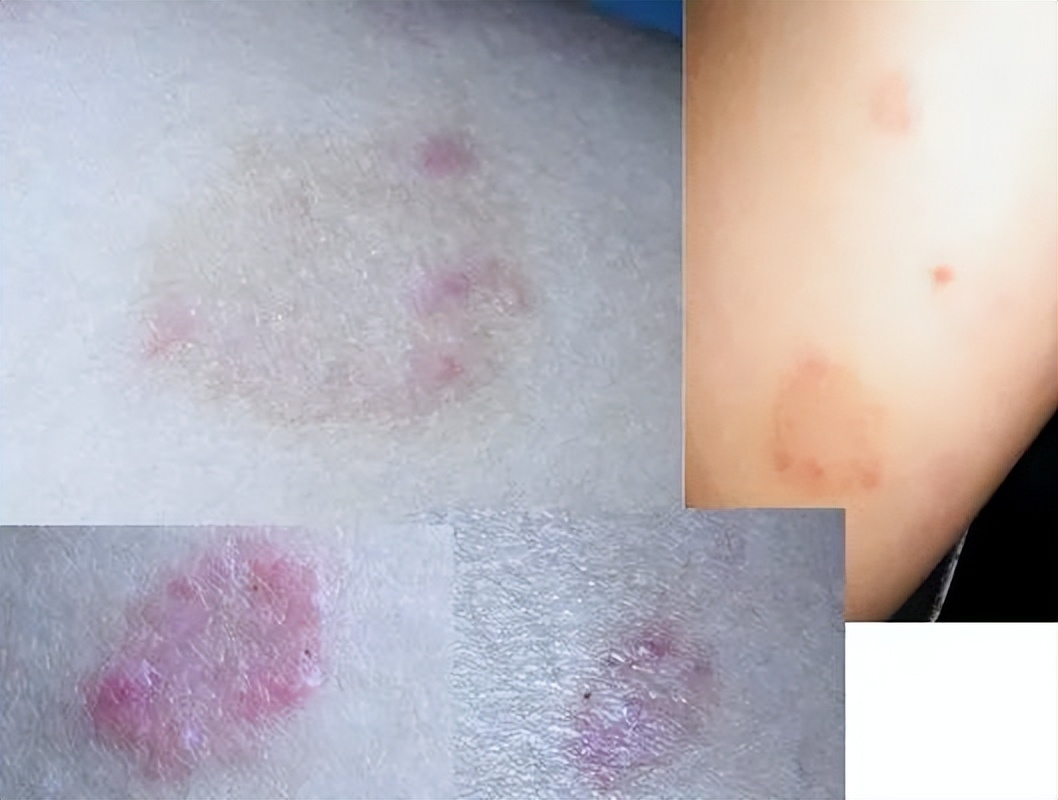 银屑病头皮屑症状中医,银屑病为啥头皮鳞屑厚