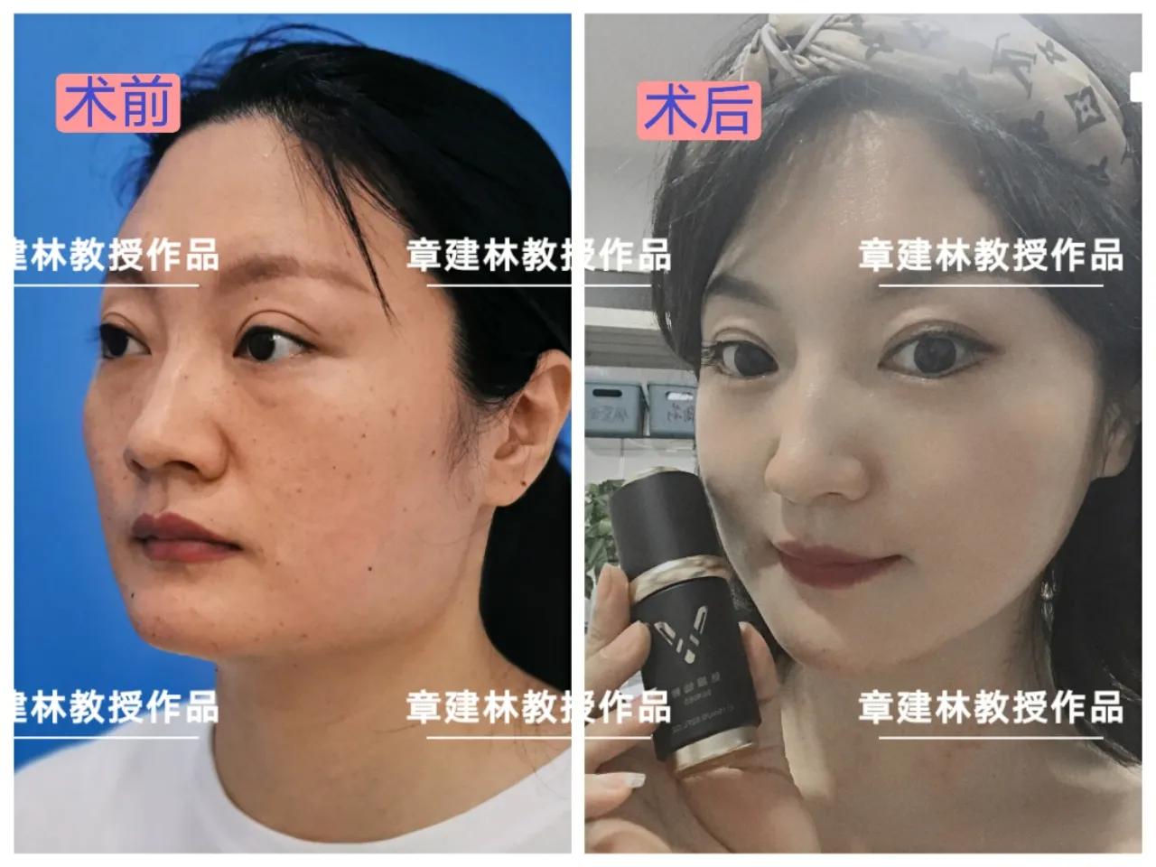 做下颌角有无年龄限制,四十岁还适合做颧骨手术吗