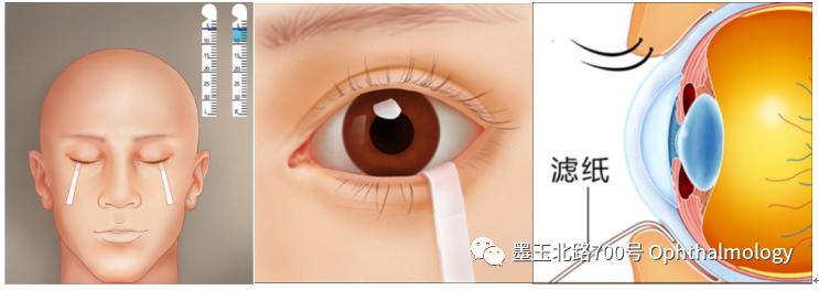 干眼症用什么眼药水,干眼症眼痒的正确解决方法