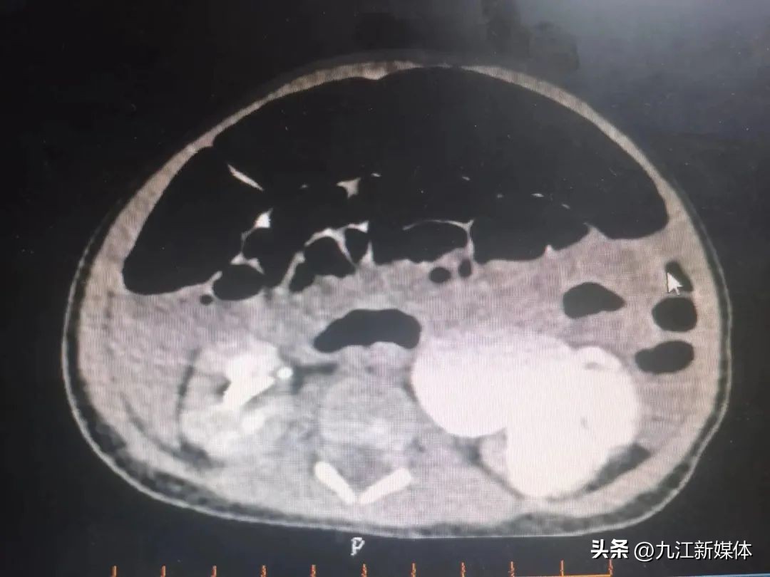出生婴儿肾积水,刚出生的婴儿肾积水1.4厘米