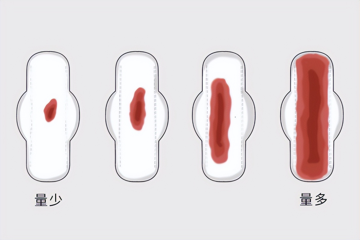 大姨妈一直不走怎么回事怎么治,大姨妈一直不走是什么原因造成的