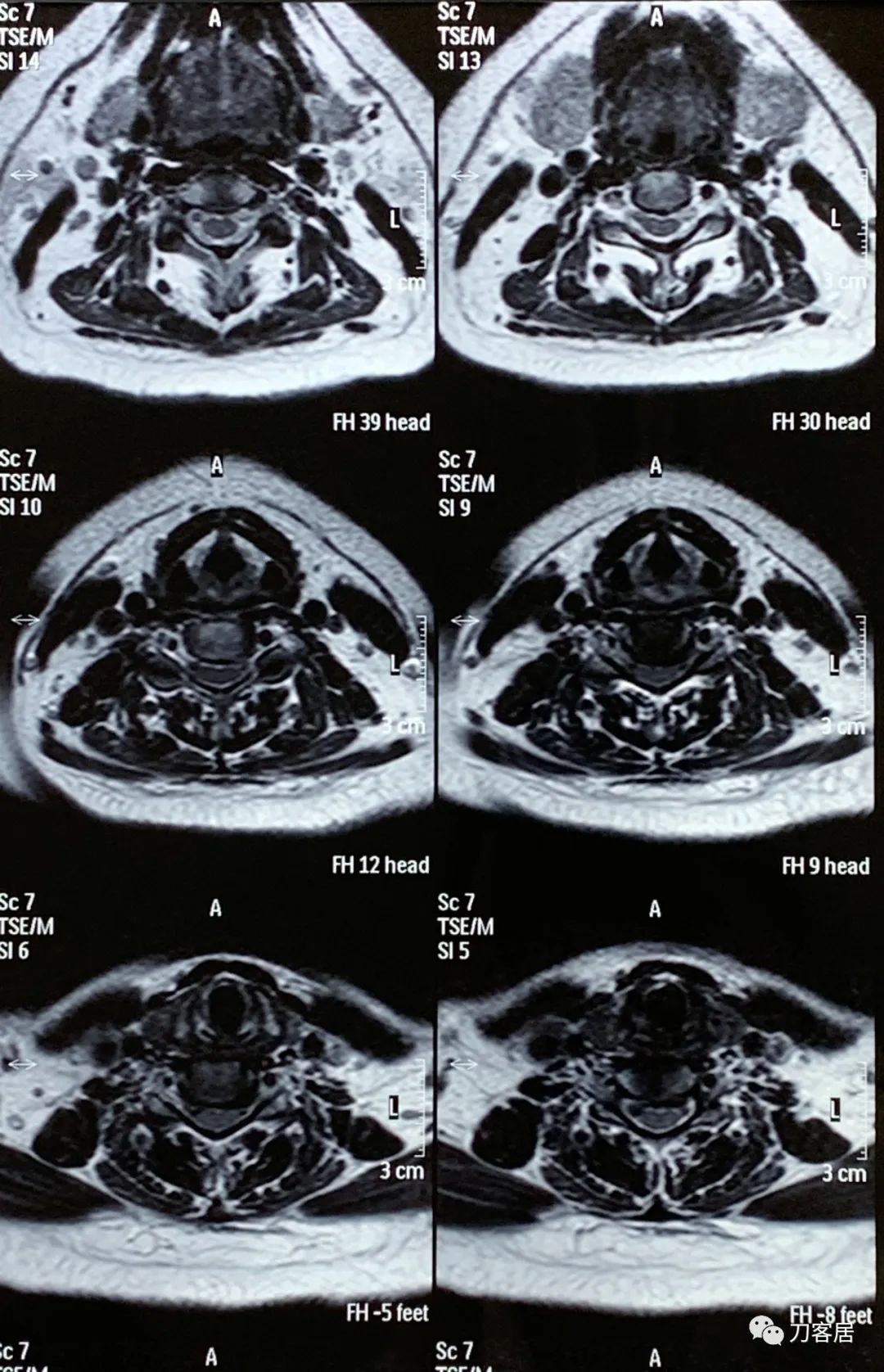 颈椎病十年了手臂酸痛肩背痛,颈椎病十年了一直痛怎么办