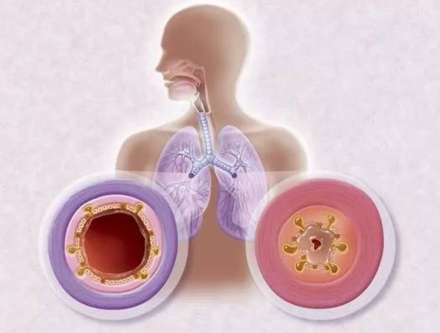 支气管哮喘痰液粘稠的预防,嗜酸性气道炎变异性哮喘怎么治疗