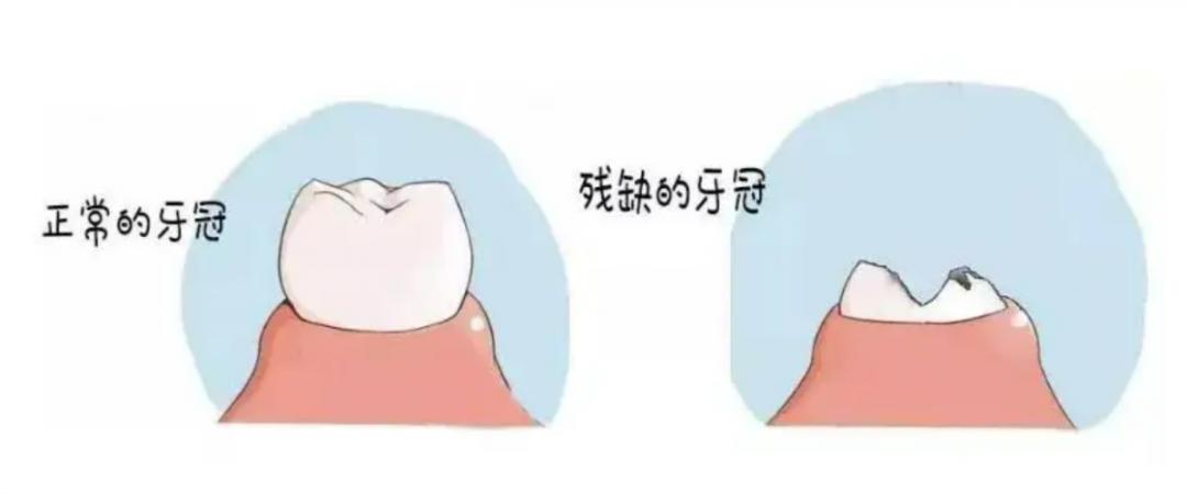 牙床有残根20多年了需要拔掉吗,牙只剩下残根了没法接需要拔掉吗