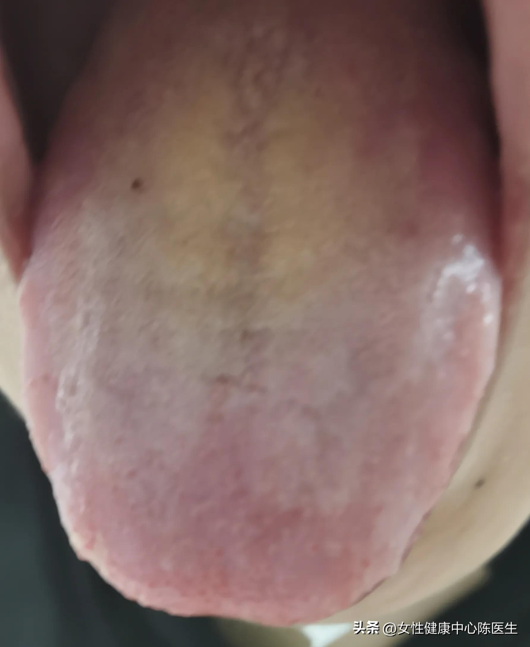 桃红四物汤治多囊卵巢,黄煌温经汤治疗多囊卵巢综合征