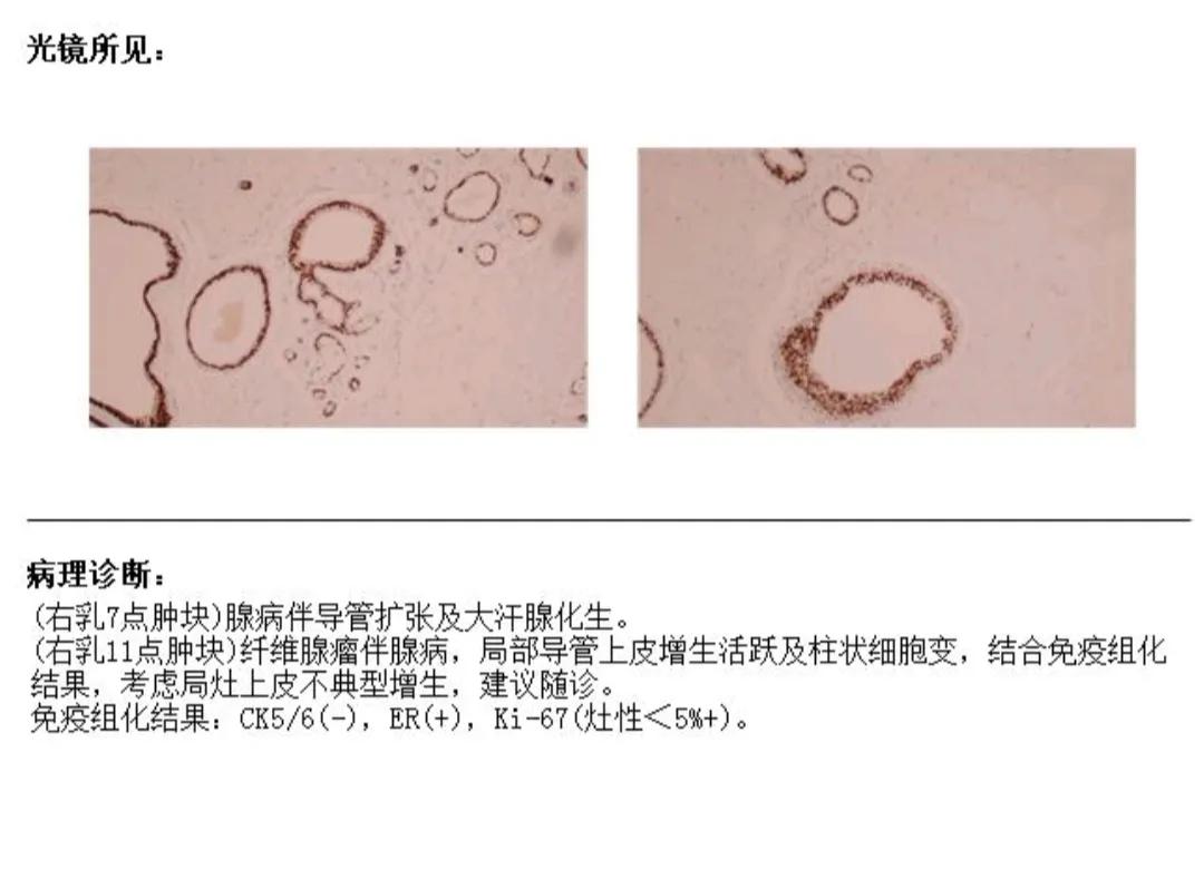 乳腺结节手术及恢复是全过程,乳腺结节微创手术治疗的过程