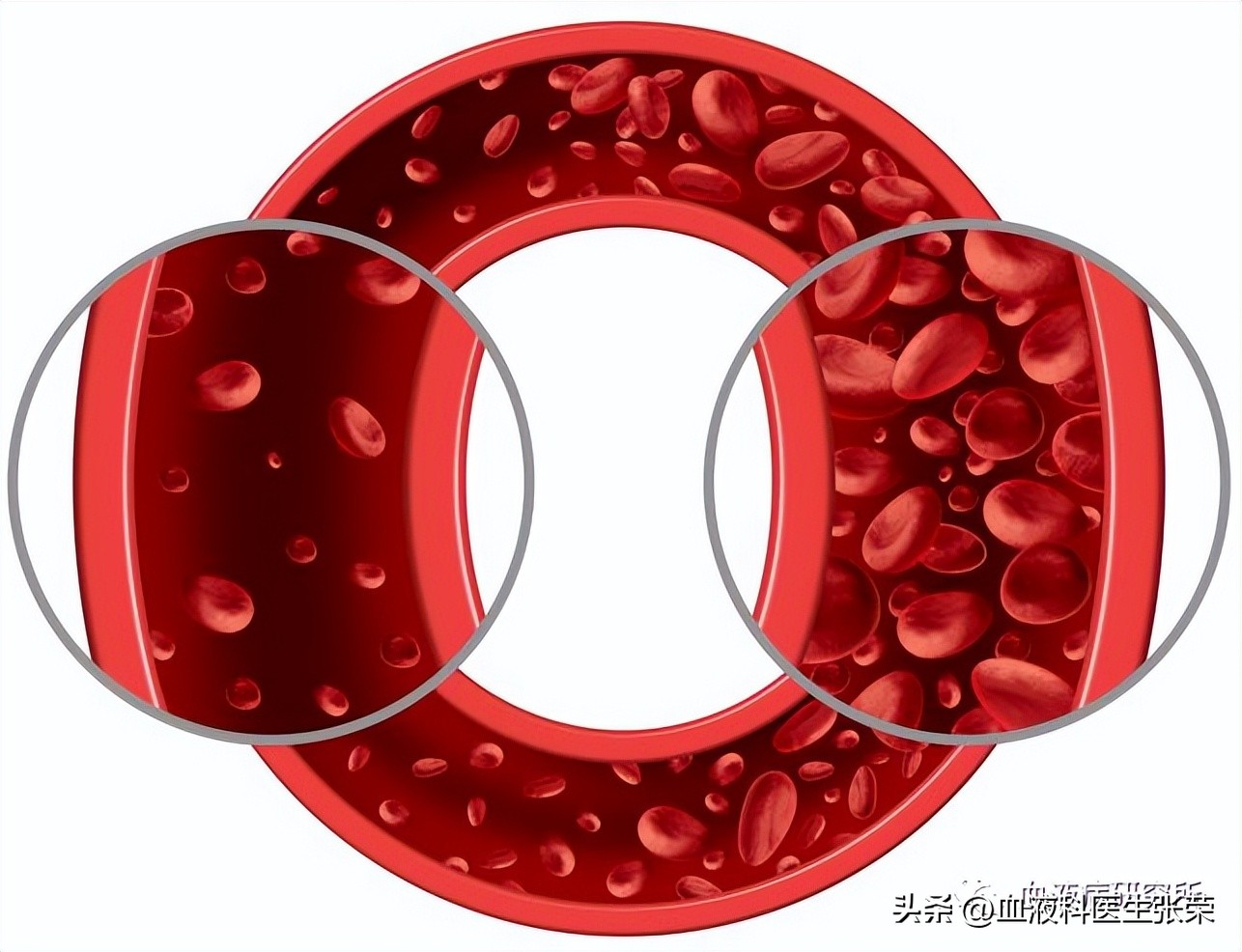 阵发性睡眠性血红蛋白尿治疗首选,阵发性睡眠性血红蛋白尿发病快吗