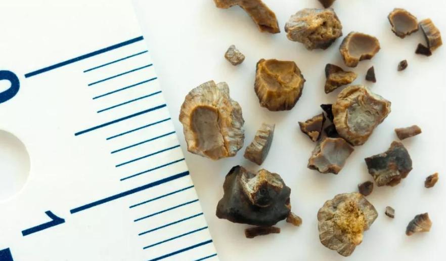 肾结石是什么病，治疗不及时会发生什么？术后护理需要注意些什么