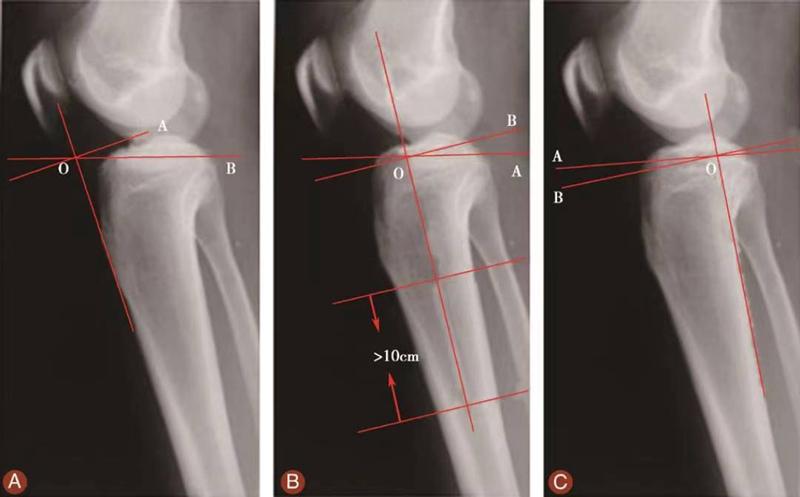 髌骨骨折评估,髌骨上下滑动评估什么内容