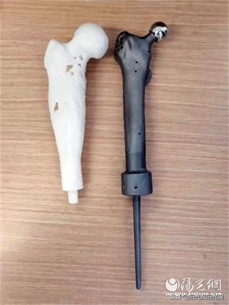 骨肉瘤3D打印假体,肿瘤型膝关节假体重建手术记录