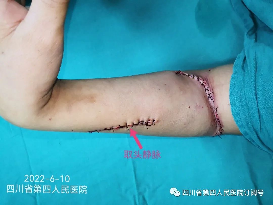 胳膊被锯断手术接上后多久恢复,肘部神经断裂恢复的案例
