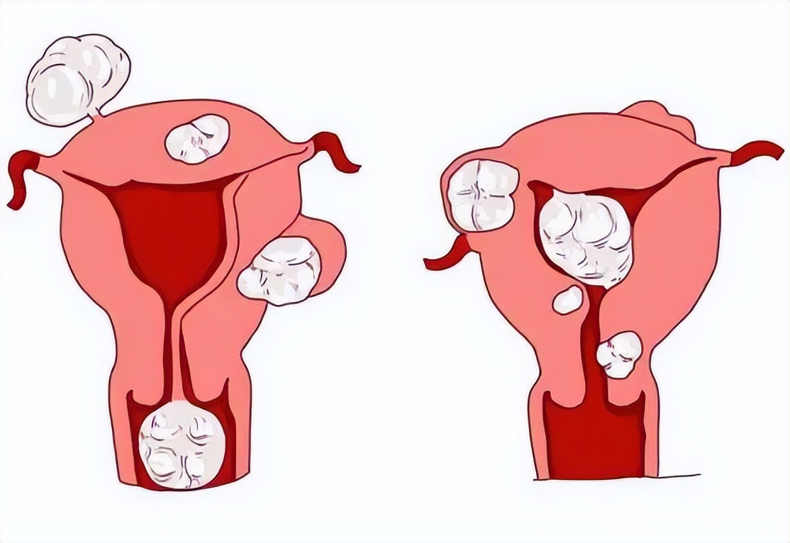 子宫肌瘤什么情况下要切除,子宫肌瘤可以反复切除吗