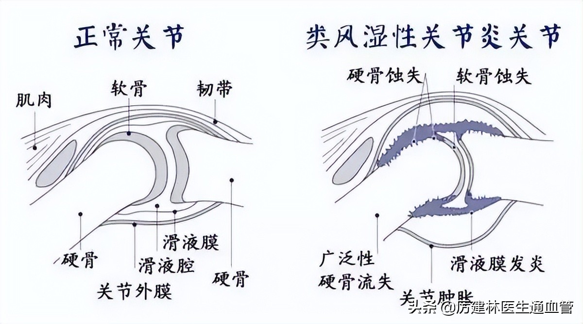 从炎症到癌症三种炎症别拖着,从炎症到癌症需要多久