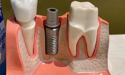 种植牙之前你一定要搞清楚这7件事？