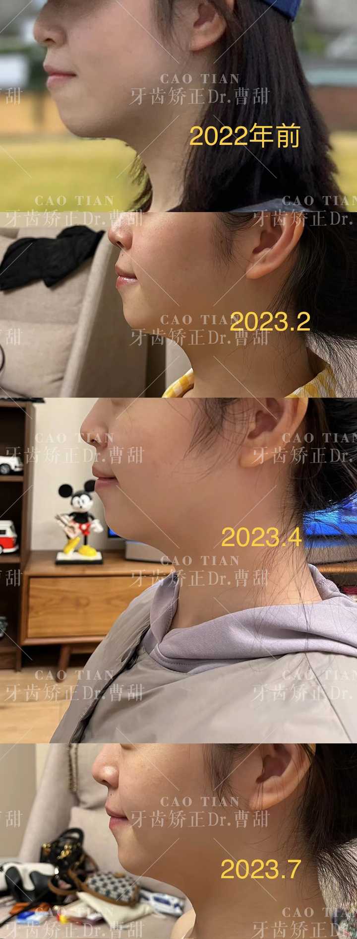 隐适美牙套脸型变化,戴隐适美牙套