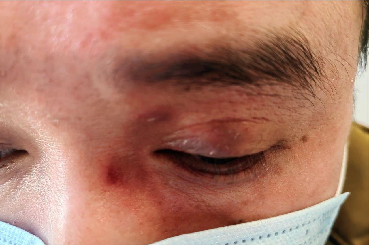 面部皮炎的症状和治疗方法,面部皮炎是怎么回事