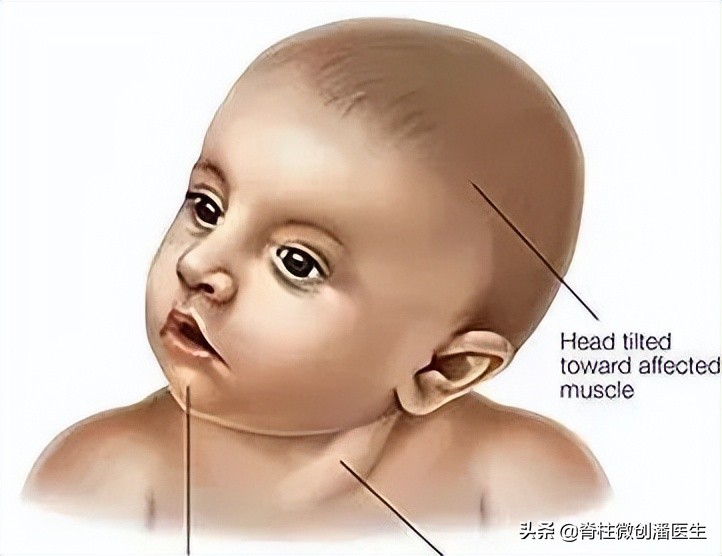 宝宝脖子右歪应该往哪看,百天宝宝脖子光往一边歪