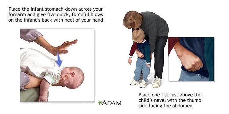 宝宝误吞硬币妈妈急救,宝宝吞硬币海姆立克急救法