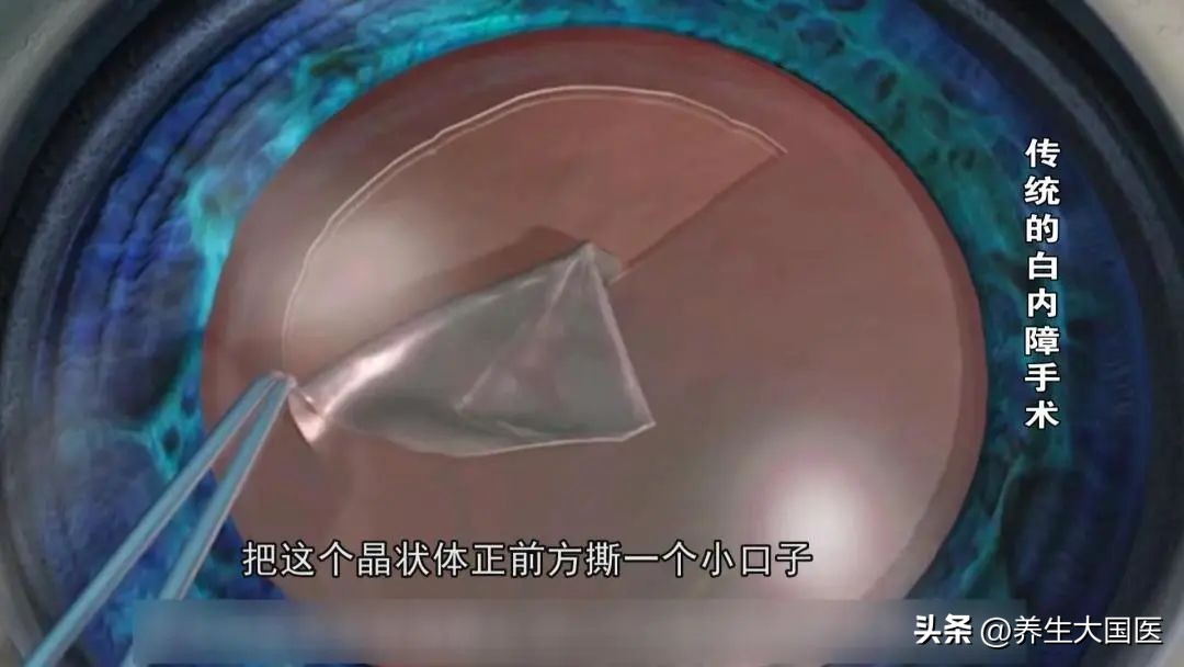 用飞秒激光治疗白内障能治散光吗,白内障飞秒激光近视手术在哪里做