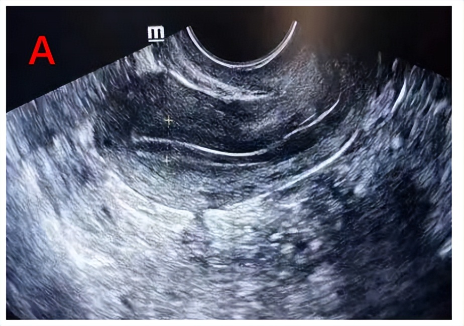 助您好孕——B超监测排卵不可不知道的细节