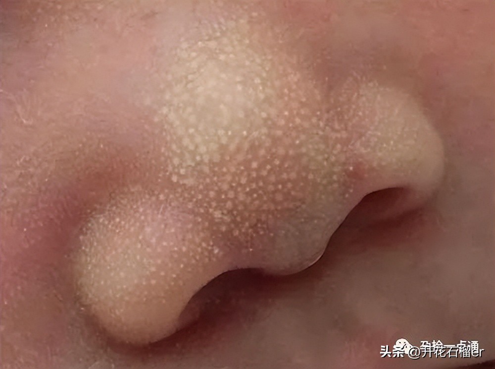 新生儿这5大状况你最担心哪个,新生儿有些表现不用治您知道吗