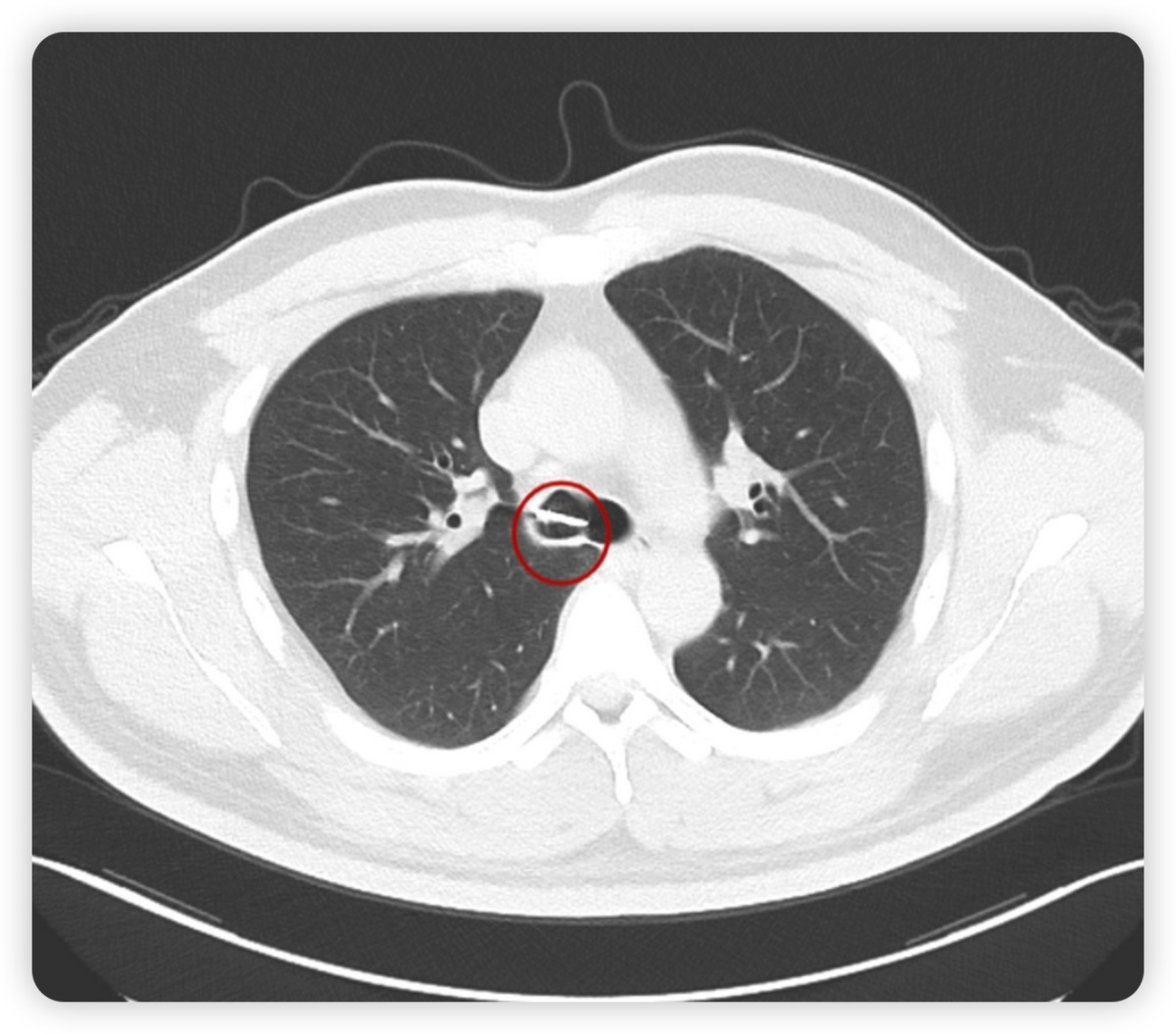 小儿做支气管镜能取出异物吗,医院支气管镜取出异物多少钱