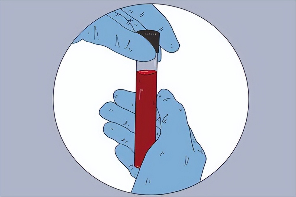 血常规四个指标升高需要注意什么,血常规检查之后才看哪三项