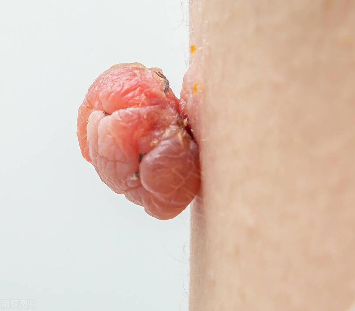 梅毒的症状潜伏期最长多长时间,梅毒的潜伏期一般为多长时间