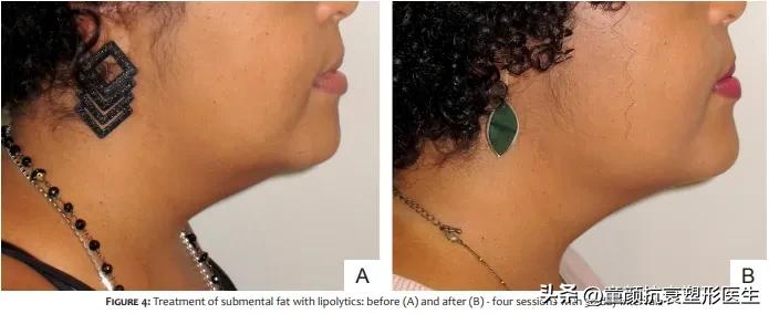 抽脂针瘦脸,抽脂溶脂针