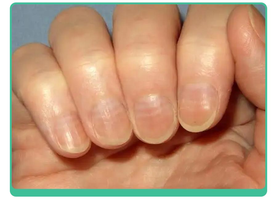 白斑、薄脆、凹陷，娃指甲有异常，不是缺营养，可能暗藏疾病