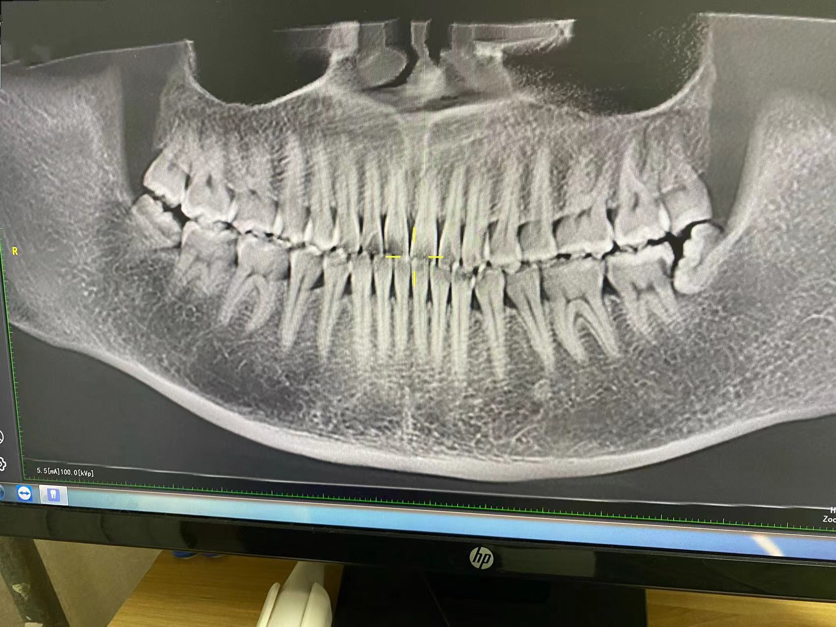 拔智齿拆线后隐隐作痛,拔智齿后痛多久算正常