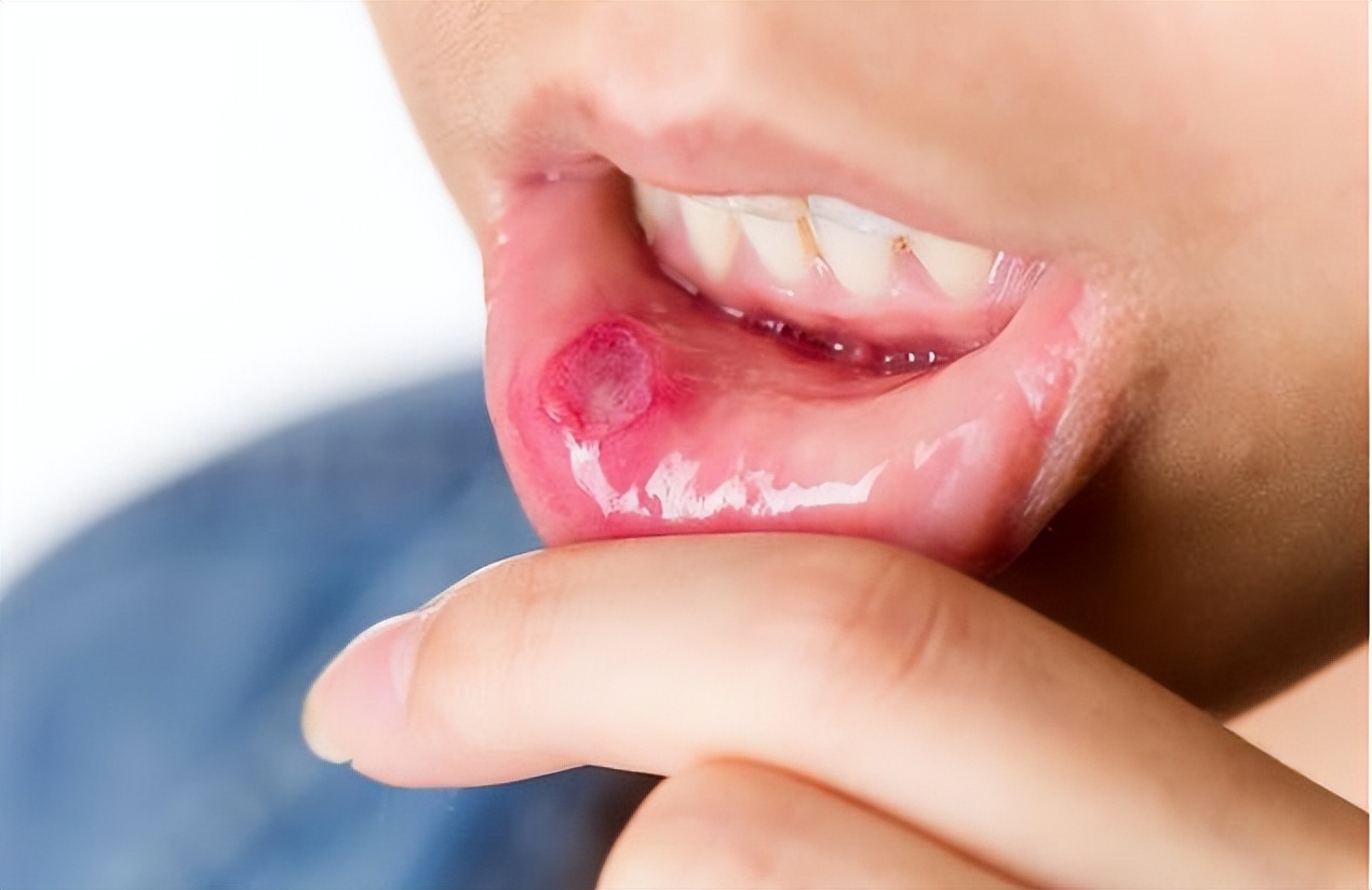 口腔溃疡总是反反复复该补什么,口腔溃疡反反复复不好该怎么办