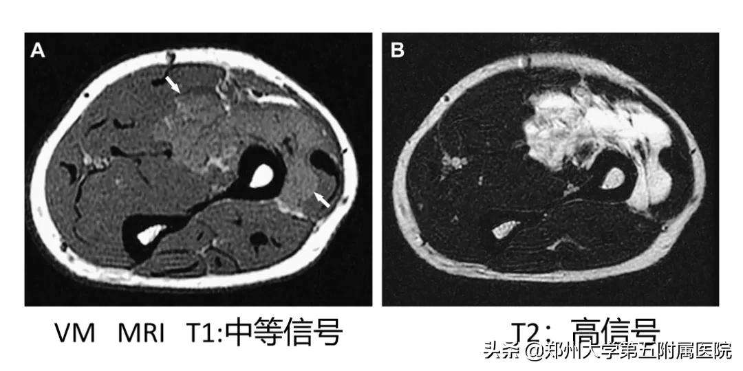健康科普治疗结节,静脉畸形有硬肿块要做手术吗