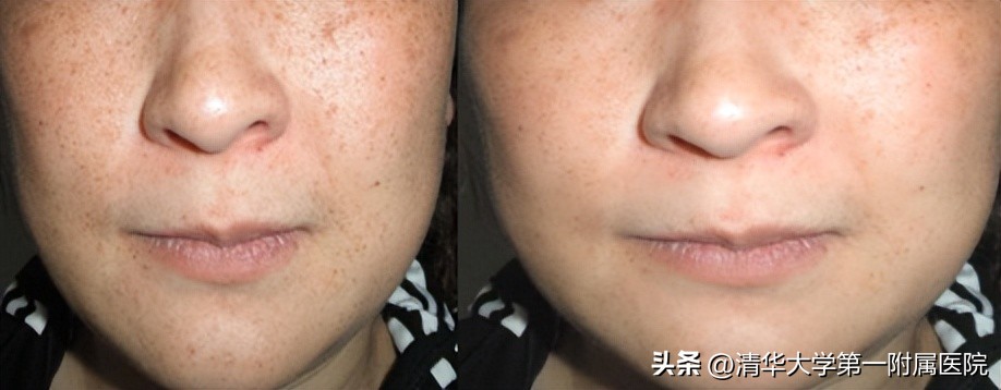 来深度了解皮秒激光美白祛斑效果,一起美起来