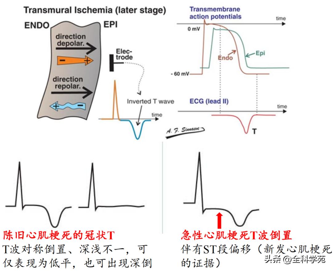 t波倒置三种常见原因,t波低平倒置有事吗