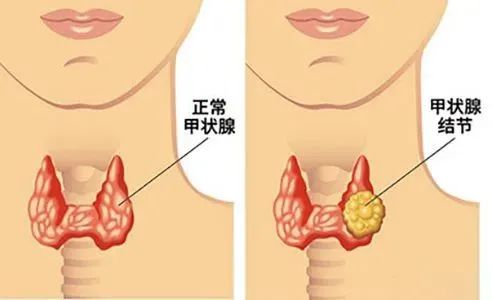 保护甲状腺（二）丨带你读懂甲状腺检查报告解析