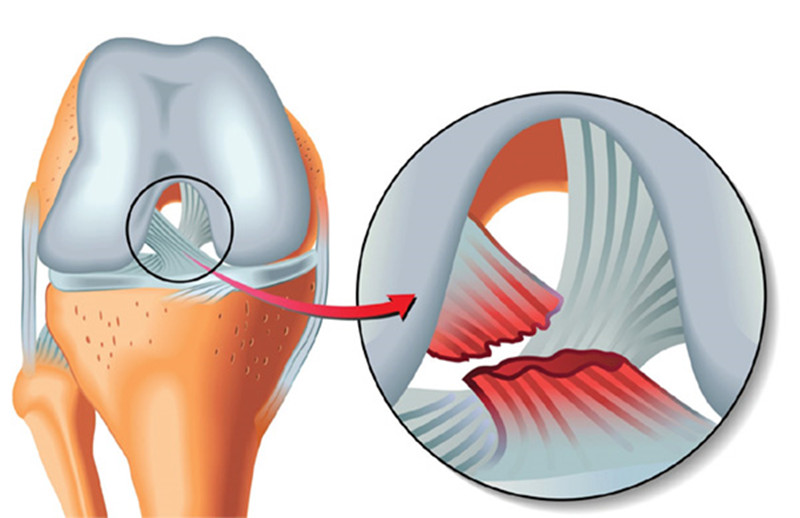 膝盖前韧带断裂二度如何判断,膝盖韧带撕裂为什么第一晚那么疼