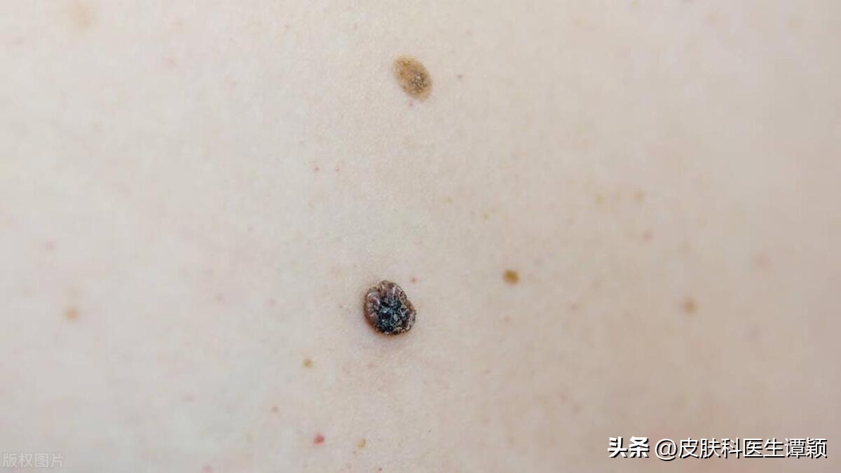 医院皮肤科医生谈痣,皮肤科色素痣科普