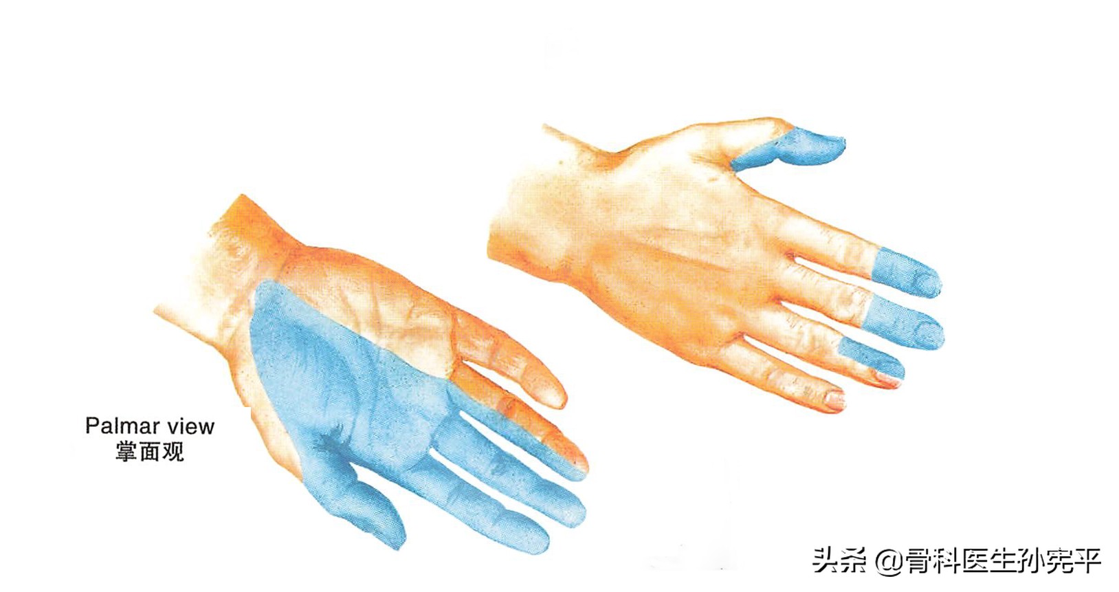 桡骨近端骨折和远端骨折哪个严重,桡骨远端骨折属于colles骨折吗